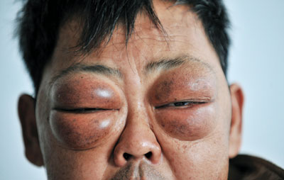 一男子双眼肿似油桃 医生半小时确诊 